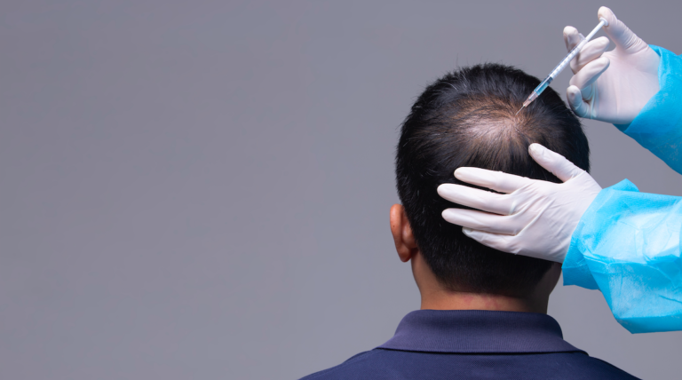 What Is the Best Treatment for Hair Loss?