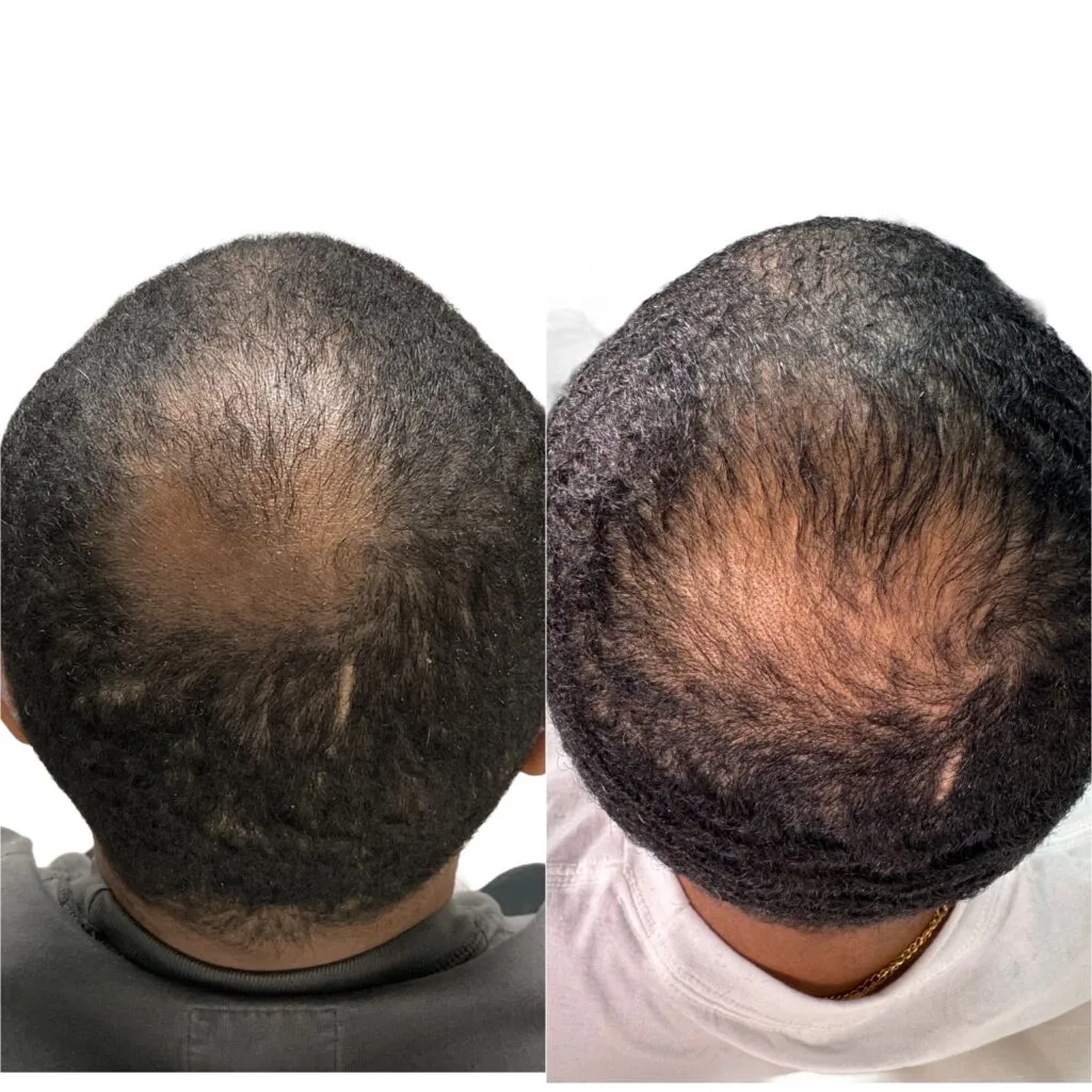 Hair Loss PRP