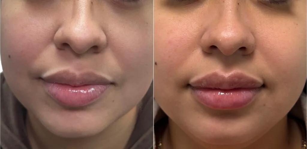 Lip Filler