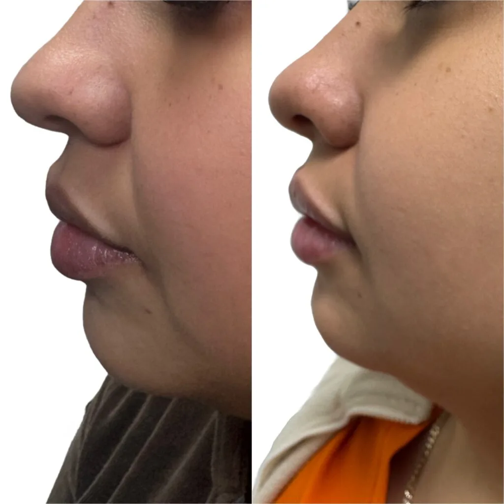 Lip Filler profile View