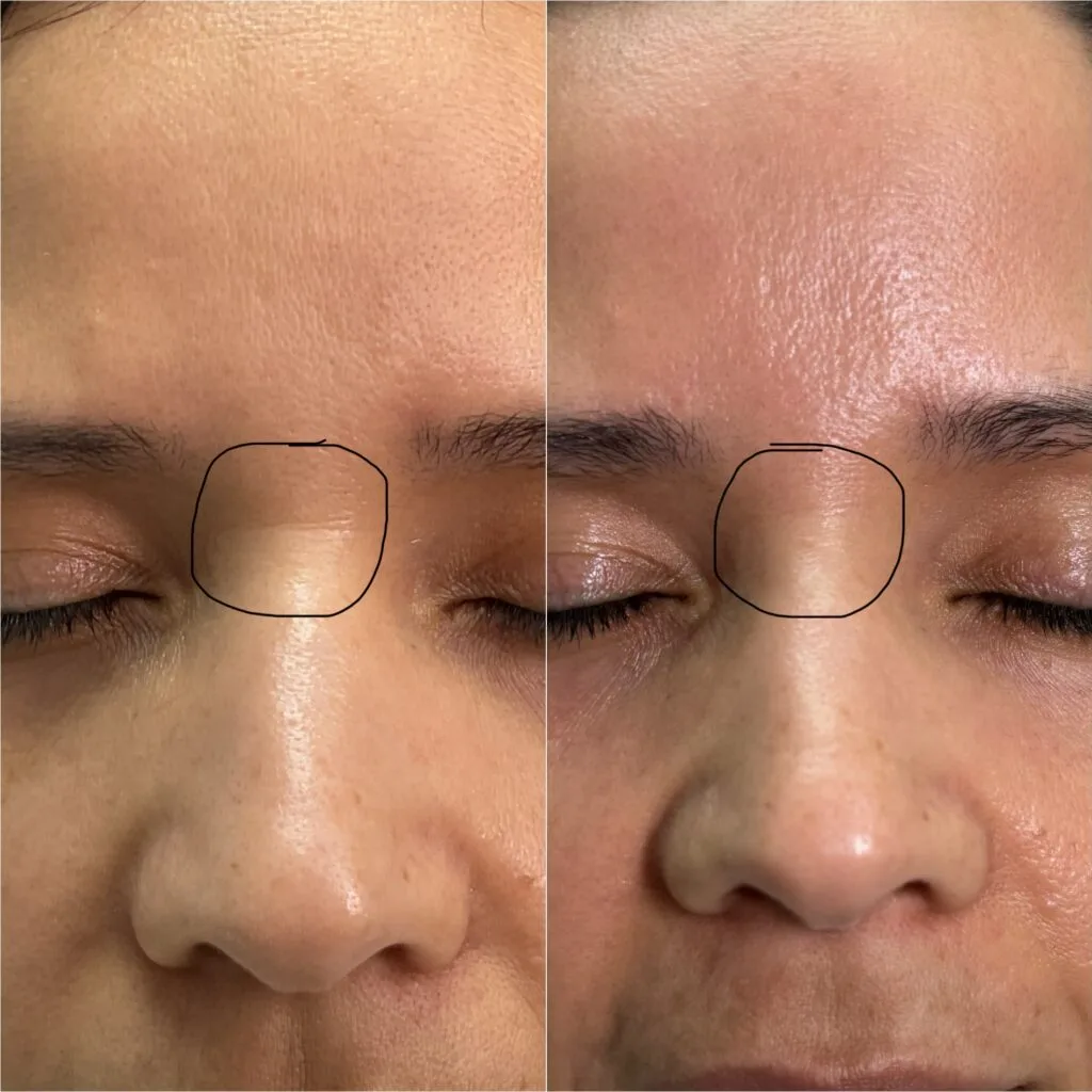 Microneedling