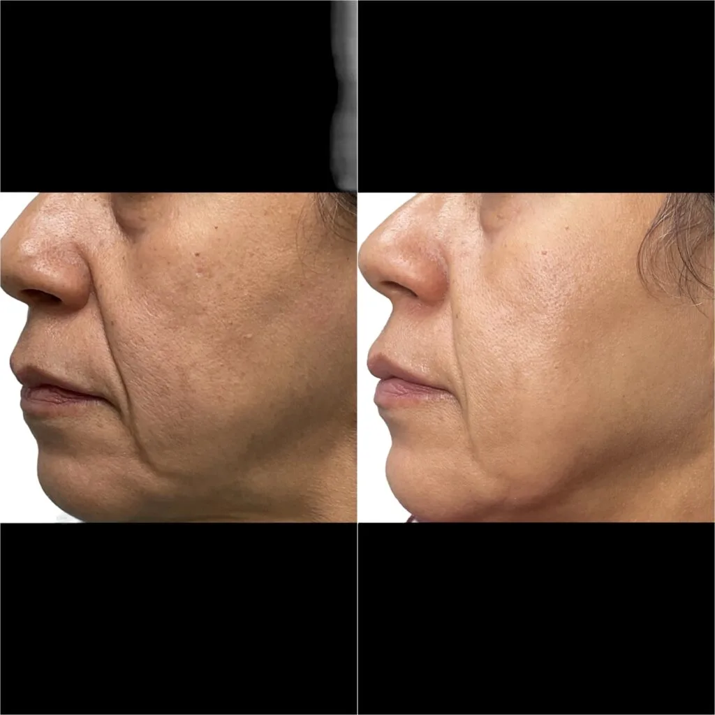 Microneedling With PRP