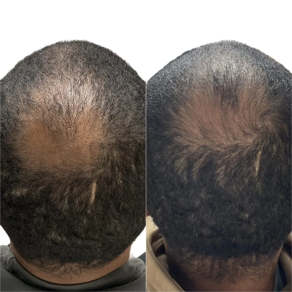 PRP Hair Loss
