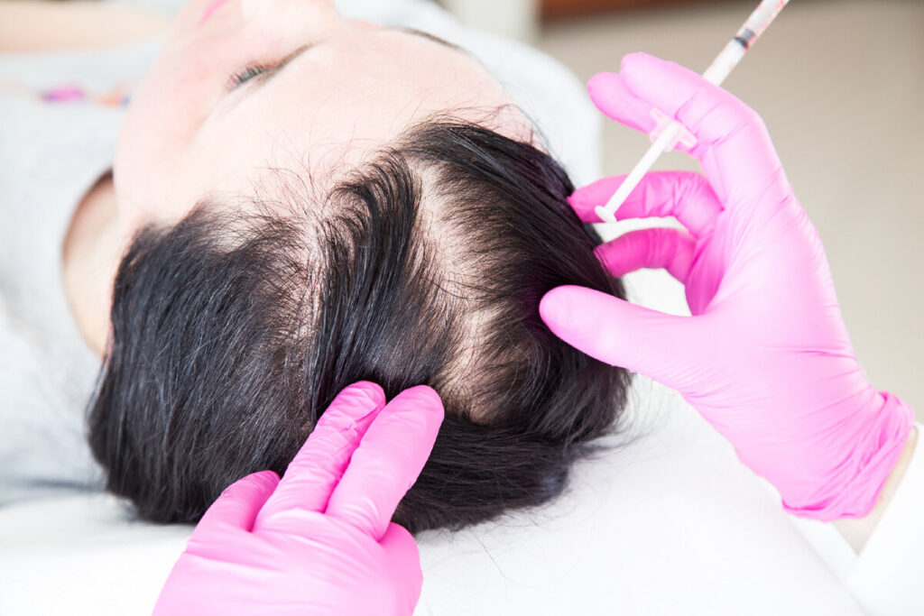 PRP Hairloss: How The Process Works?