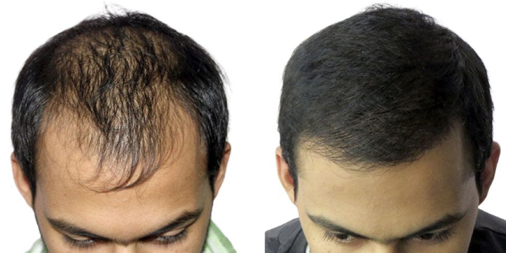 How to Fix Male Hair Loss in Queens, New York