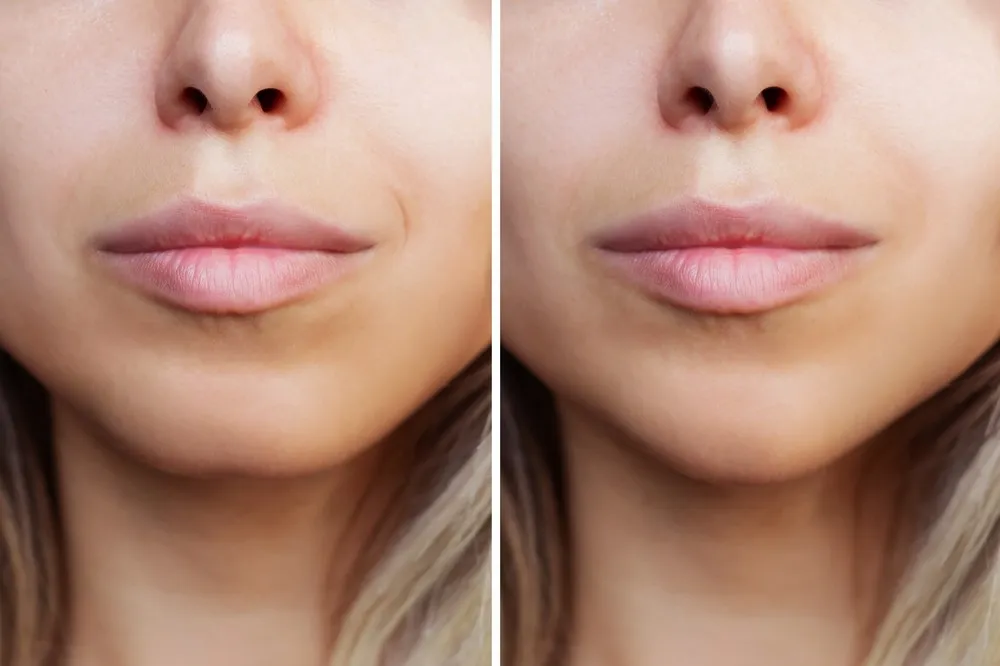 Where to Get Lip Fillers Dissolved in Queens NY