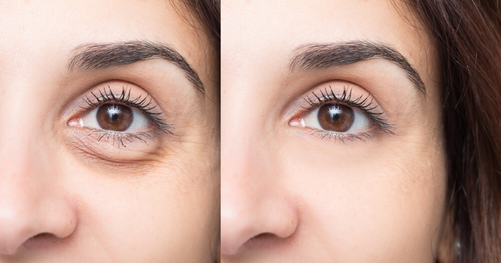 How to Treat Saggy Eyelids in 2025? Queens, New York