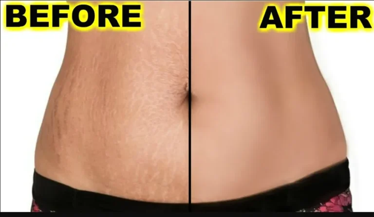 Stretch Marks before after
