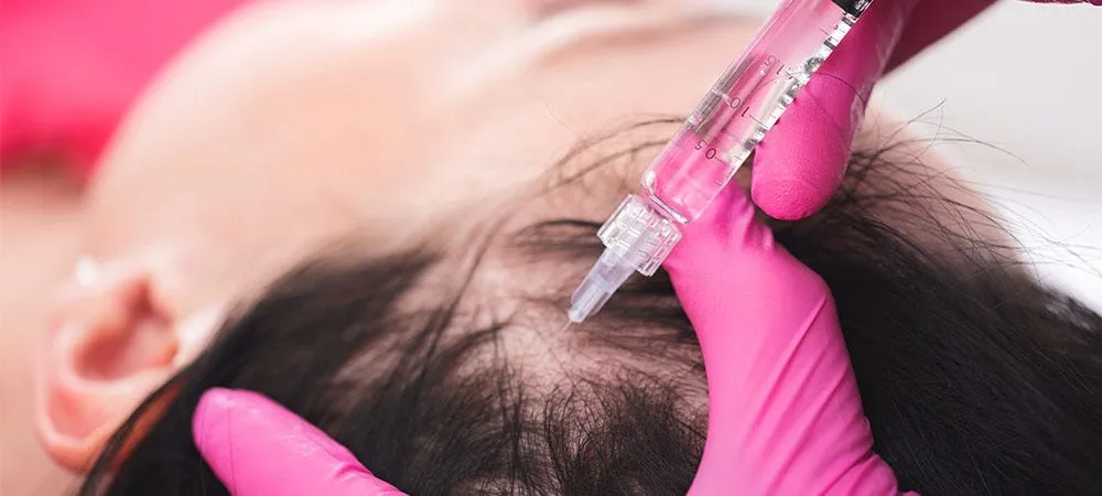 PRP Injections for hair loss