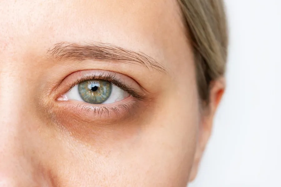 PRP Injections for dark circles