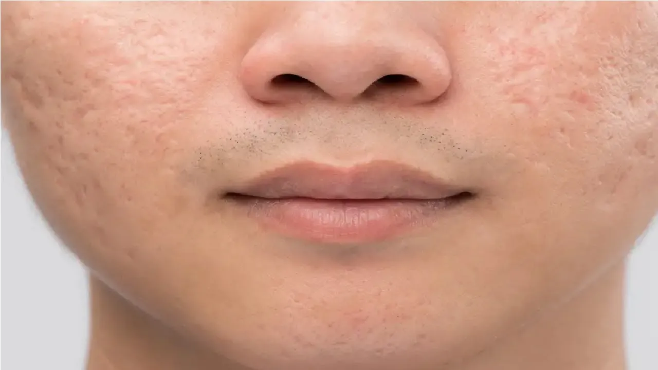 Fade Pesky Pitted Acne Scars