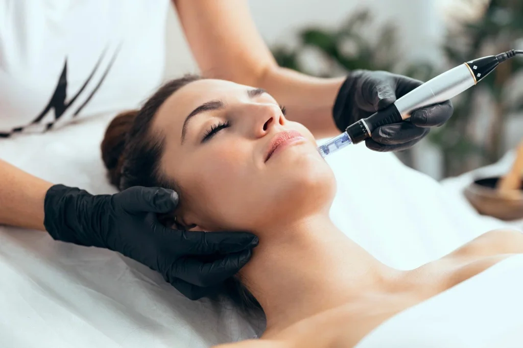 Why Queens Locals Love Our Microneedling Services